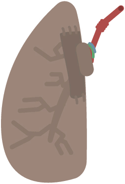 Extra Lung