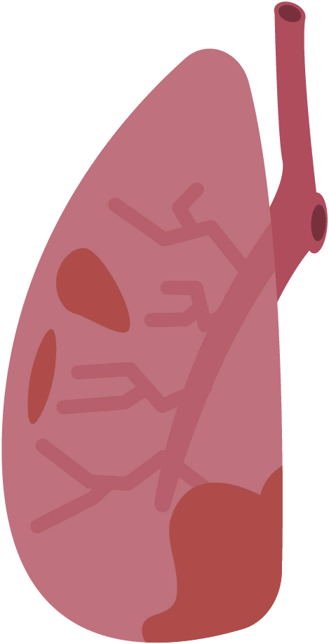 Lung